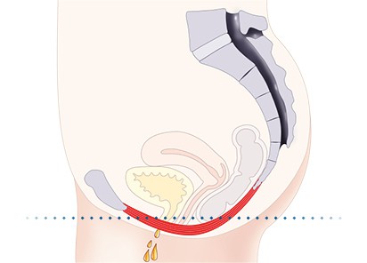 Pelvic-Floor Muscle Repair 5 Pelvic floor muscles Byfleet