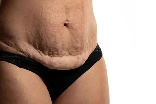 The science behind skin tightening Byfleet picture of a woman's sagging skin on the stomach
